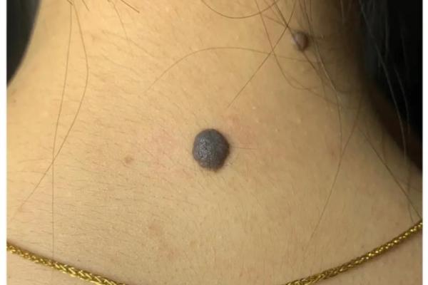 脖子上的秘密：女性相学里的痣相大全解析