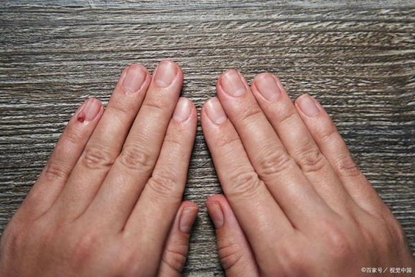 手指上的秘密诱惑：痣的神秘力量