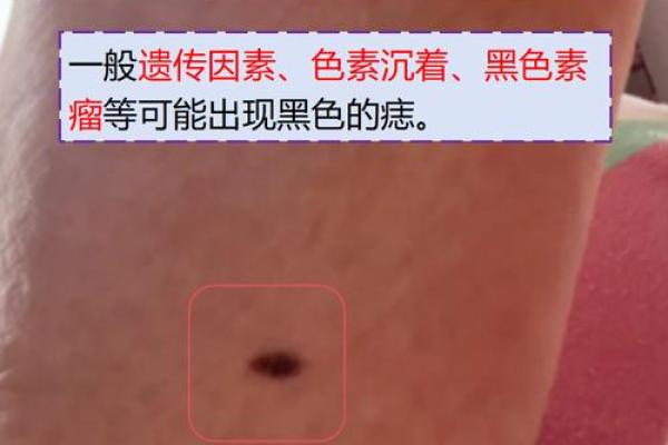 脚下痣的神秘解读：探寻你的个性与运势